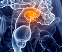 Colorectal cancer Causes